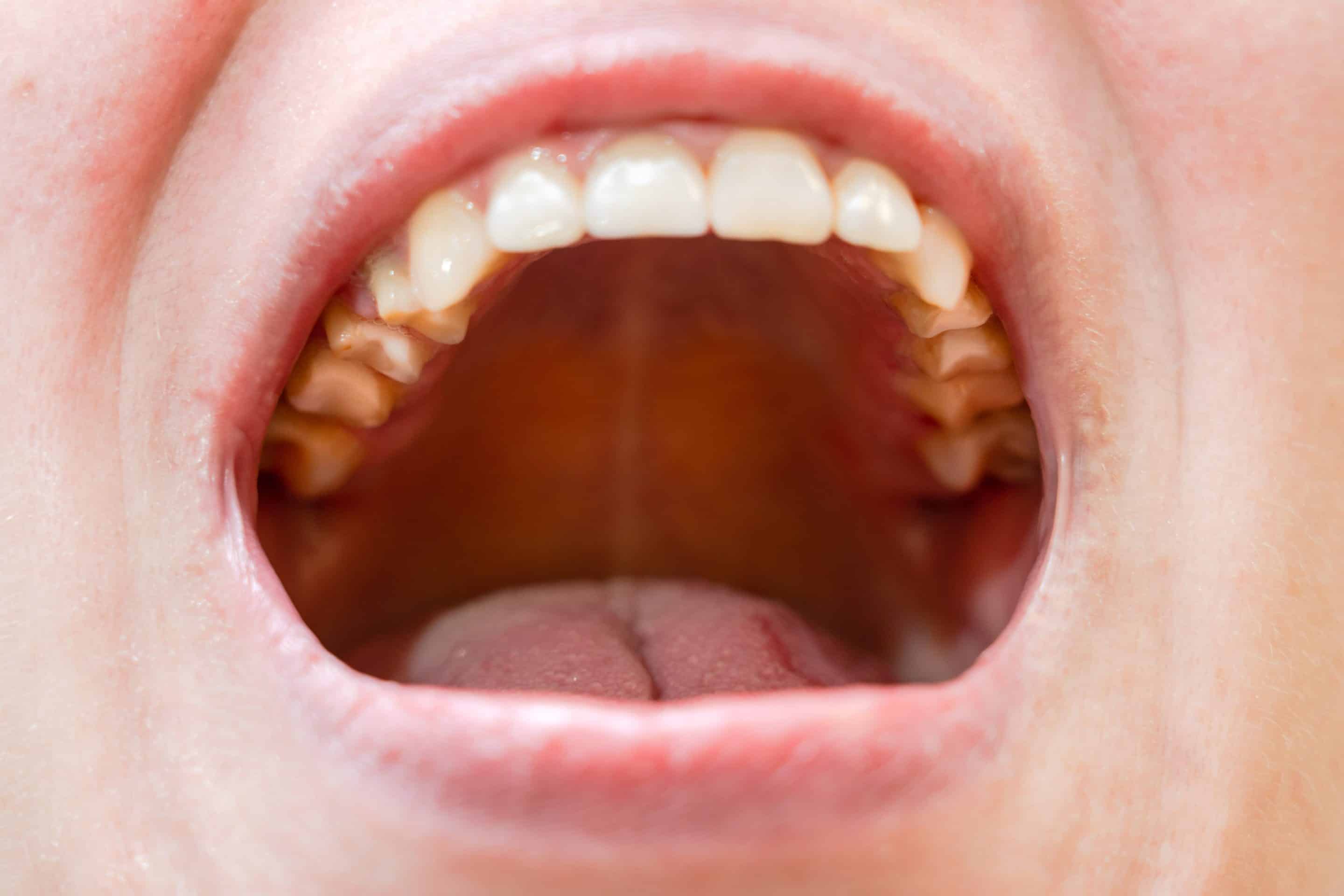 Full mouth restoration dentist in Apex, NC