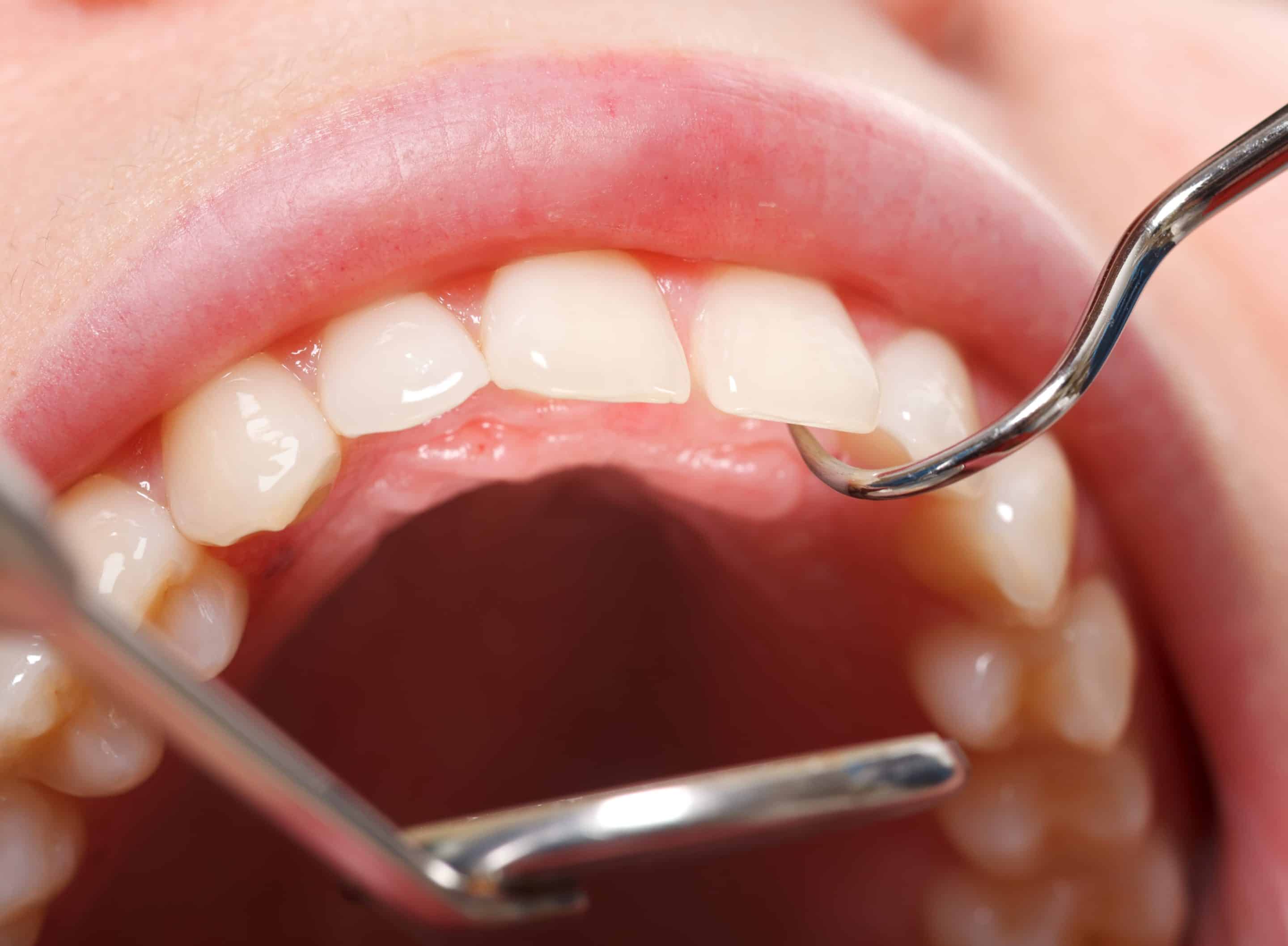 Oral cancer pathology exam in Apex, NC