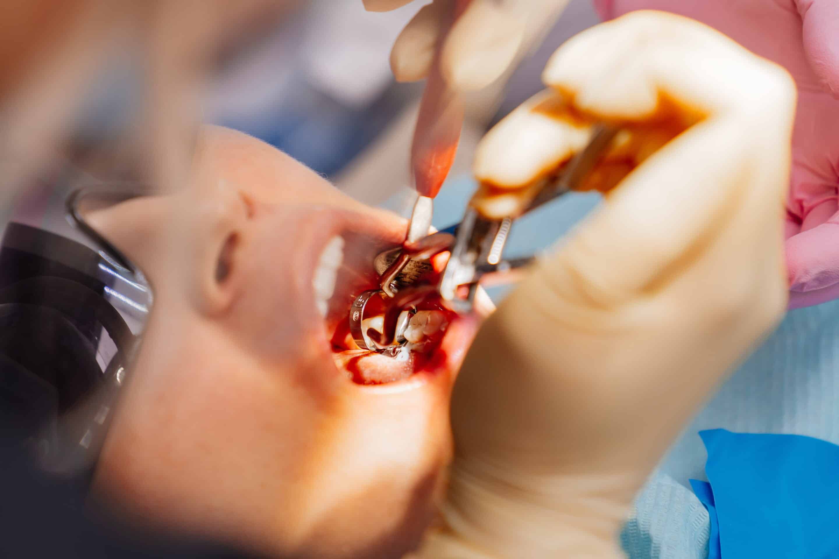tooth removal appointment in Apex, NC